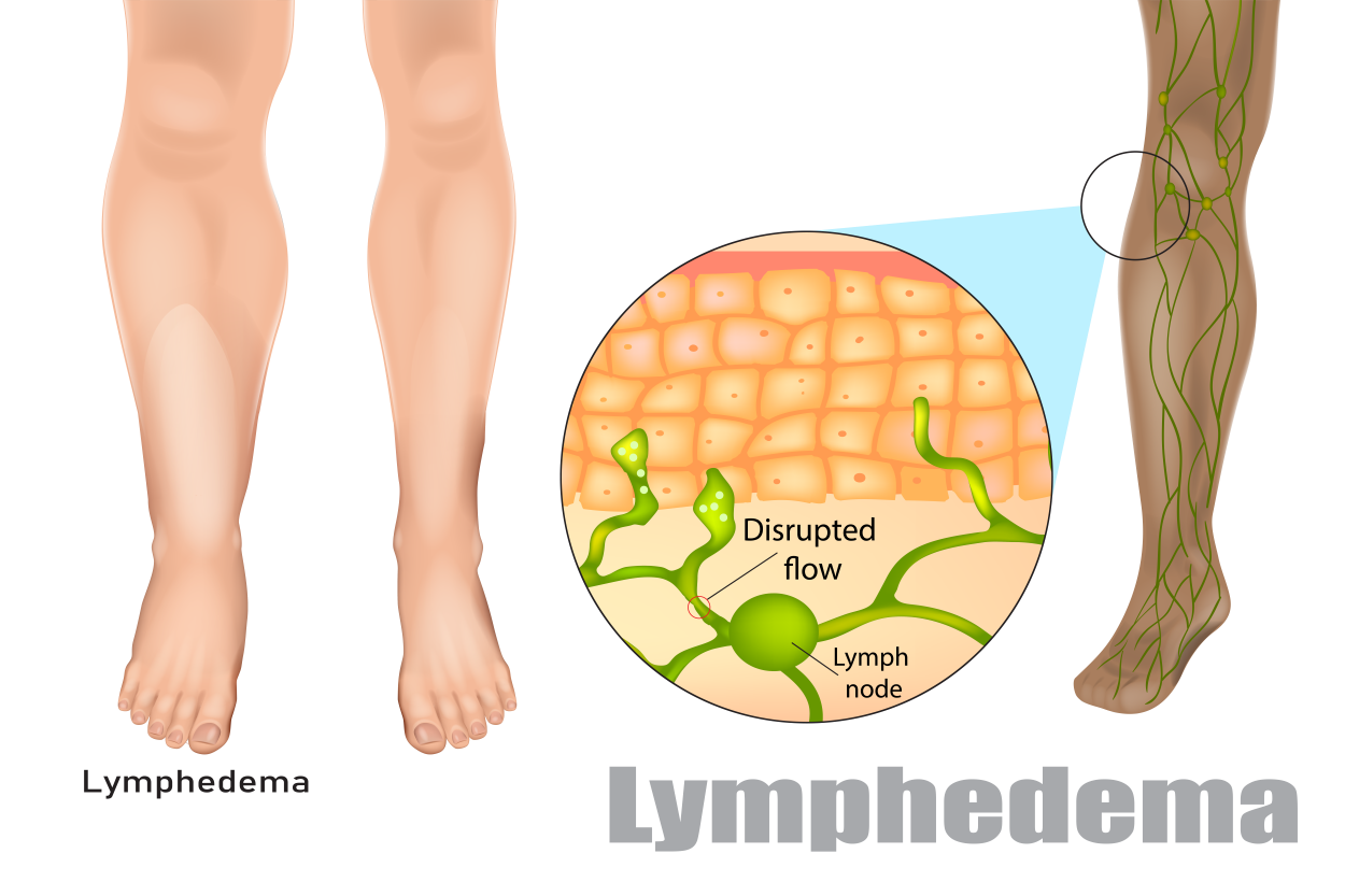 lymphedema
