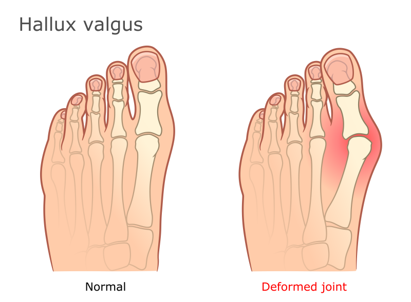 hallus valgus