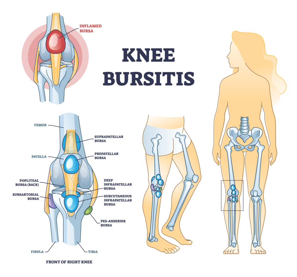 popliteal bursitis