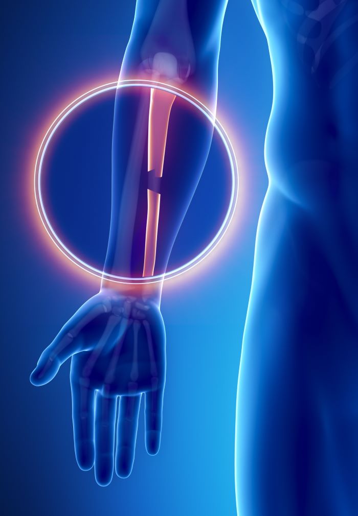 distal ulna fracture