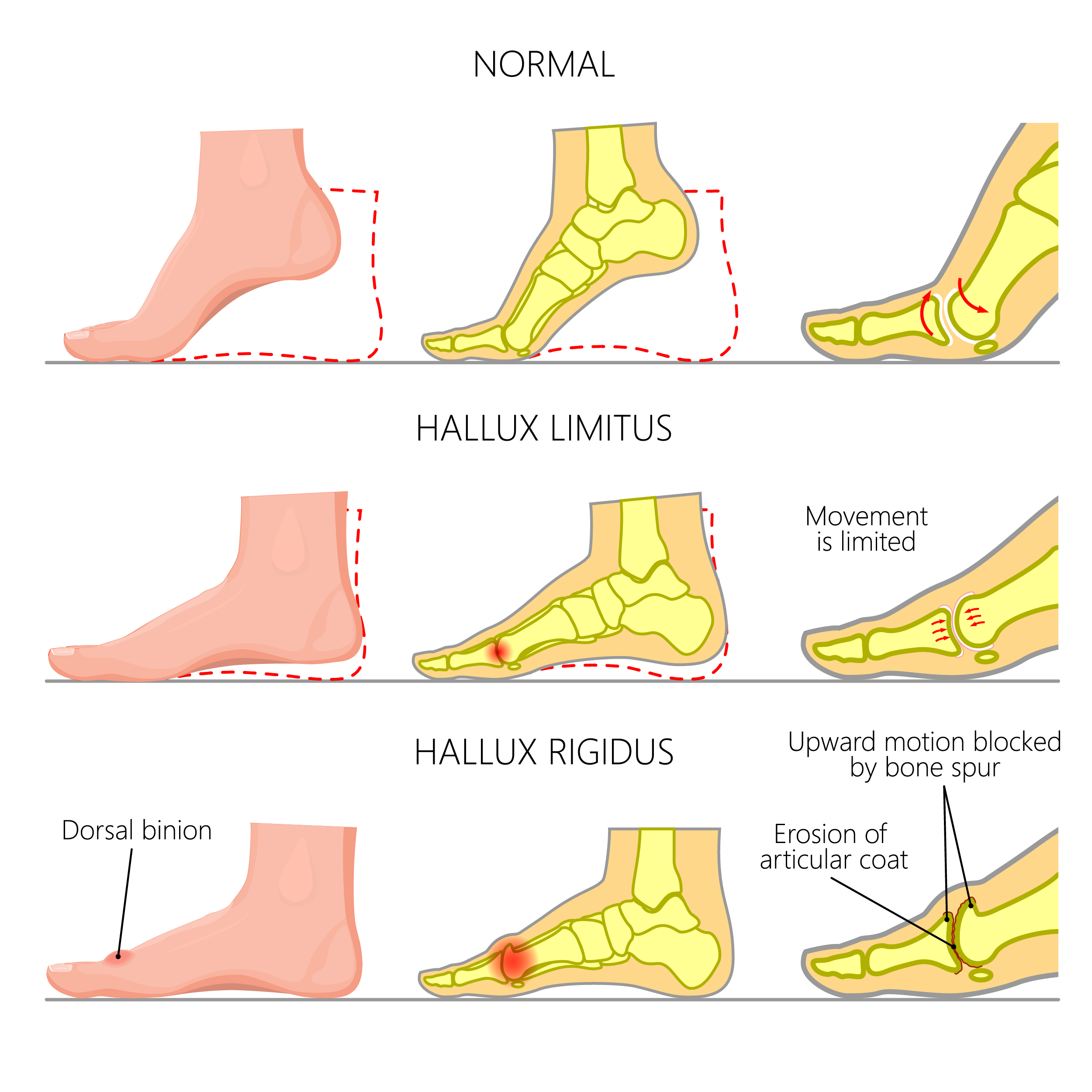 hallux