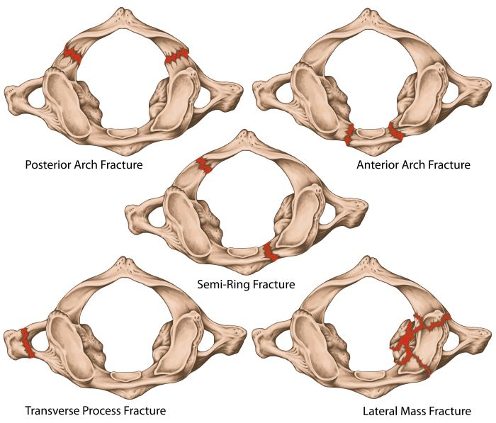 transverse process fracture
